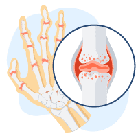 Viêm khớp
